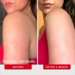 First Aid Beauty AHA Body Scrub for Keratosis Pilaris Relief - Image 3